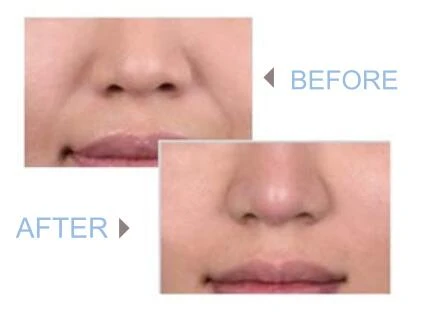 BEFORE AFTER